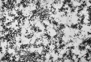 F,50y. | papilomavirus in glial cell - progressive multifocal leukodystrophy